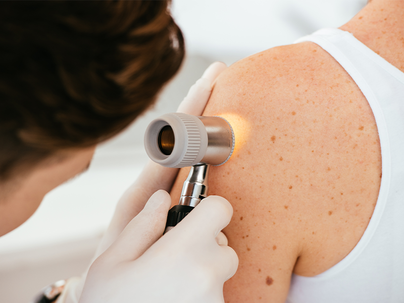 Prevenzione Tumori: L’Importanza dei Controlli Regolari e della Diagnosi Precoce